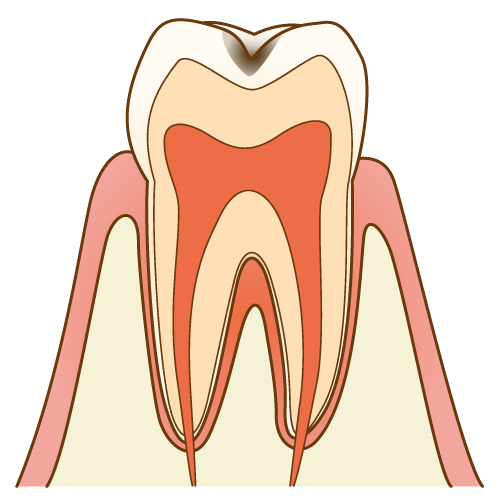初期虫歯c1