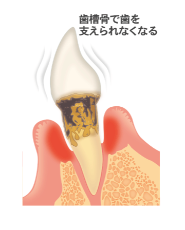 重度歯周炎