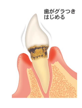 中等度歯周炎