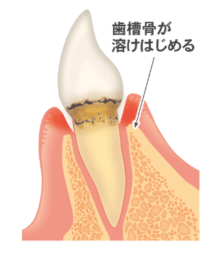 軽度歯周炎