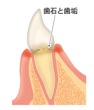 歯肉炎