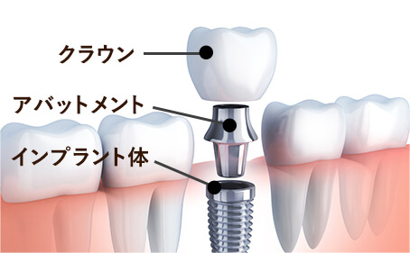 インプラントの構造